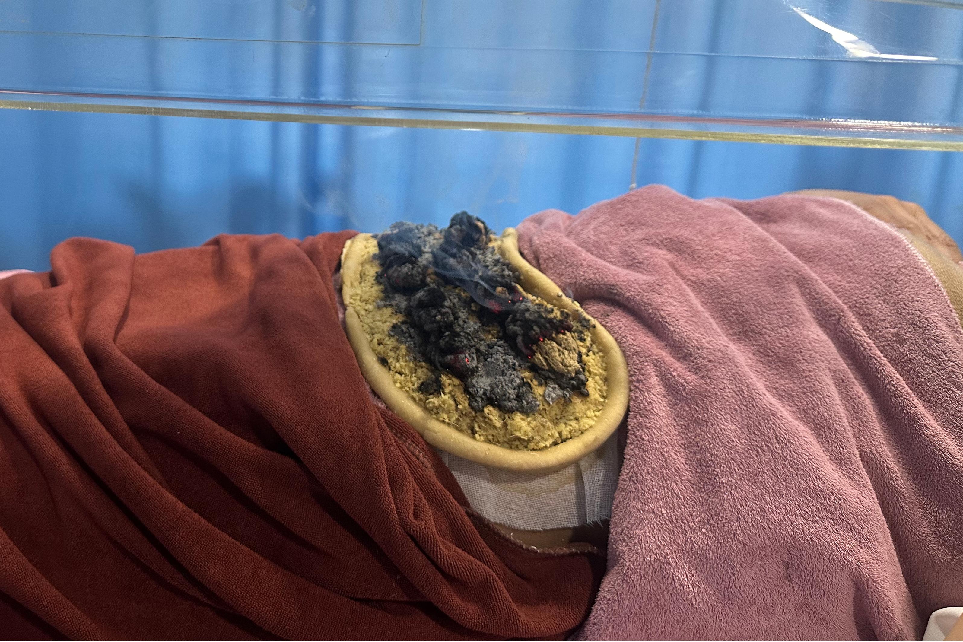 【中医特色疗法】带脉不通，小腹必胖，可以试试带脉灸！